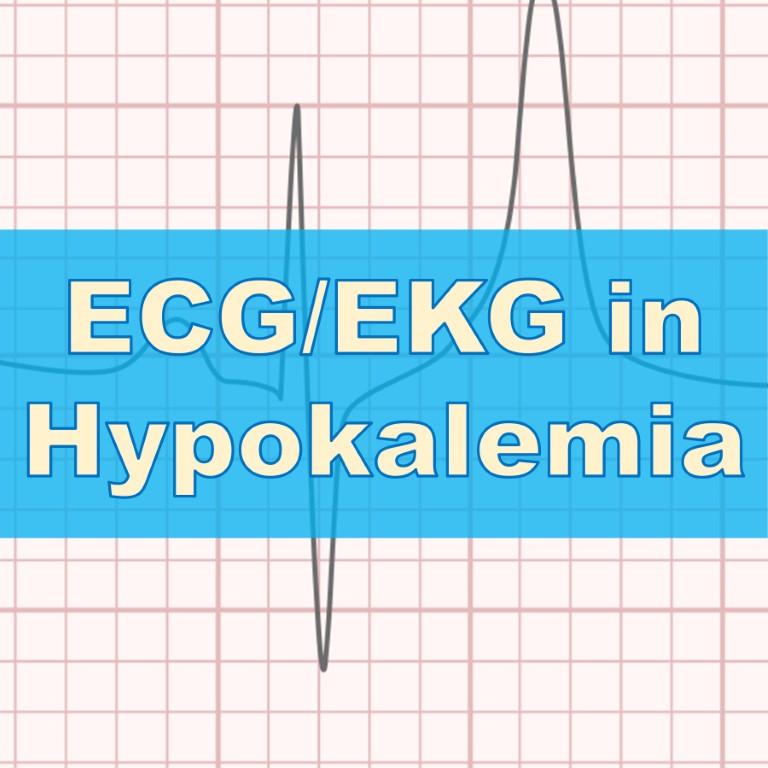 Hypokalemia ECG EKG Rish Academy