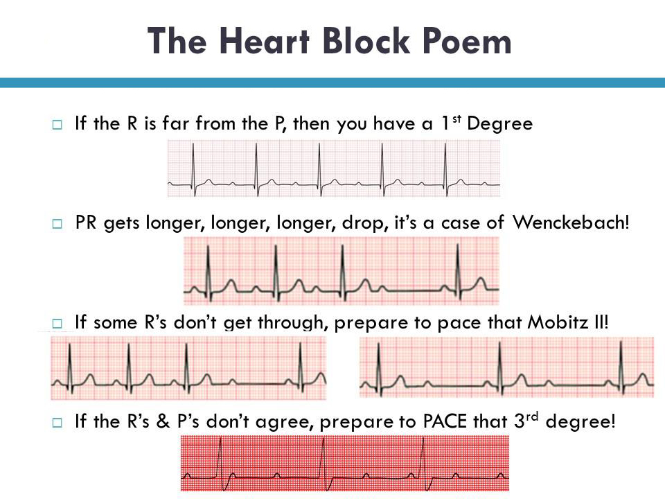 Heart Block Poem – Rish Academy