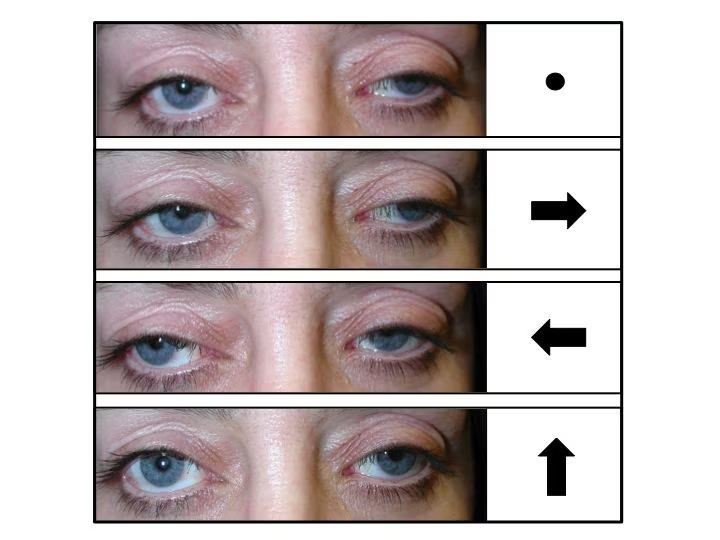 Bilateral ptosis and external ophthalmoplegia. Top patient looking straight ahead. Below patient is being asked to look in the direction of the arrow in each case. Restriction of eye movements.