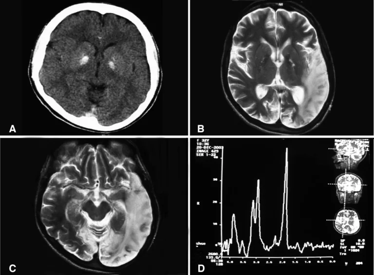 mitochondrial inheritance examples Basal ganglia calcification, cerebellar atrophy, increased lactate; a CT image of a person diagnosed with MELAS