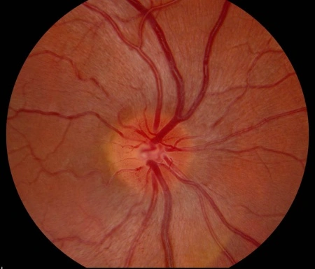 mitochondrial inheritance examples Optic nerve with peripapillary telangiectasias and pseudoedematous appearance.