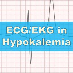 Hypokalamia ecg ekg rish academy cov