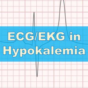 Hypokalamia ecg ekg rish academy cov