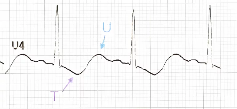 Hypokalemia ecg ekg rish academy Hypokalaemia T wave inversion and prominent U waves