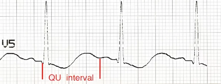 Hypokalemia ecg ekg rish academy QU interval The apparent pseudo-prolonged QT interval is actually the QU interval with an absent T wave