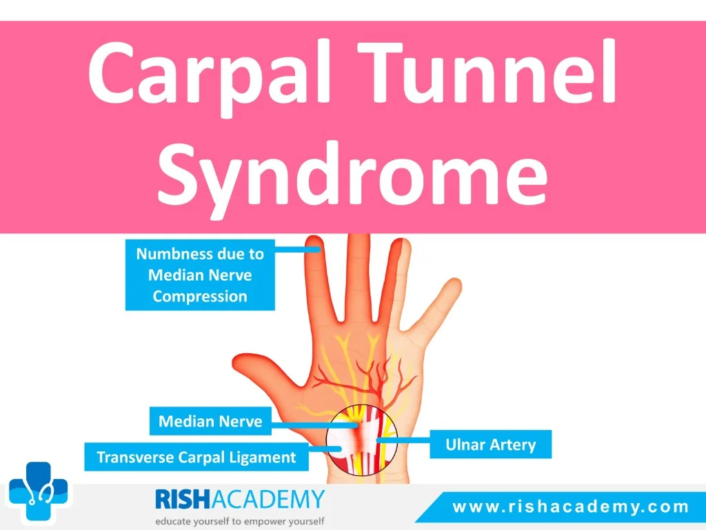 Carpal Tunnel Syndrome free medical notes rish academy (1)