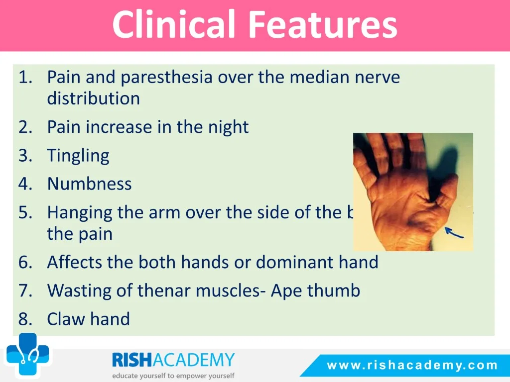 Carpal Tunnel Syndrome free medical notes rish academy (5)