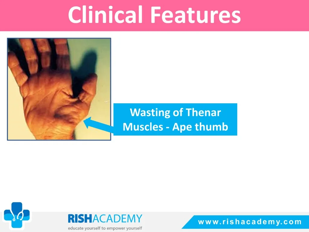 Carpal Tunnel Syndrome free medical notes rish academy (6)