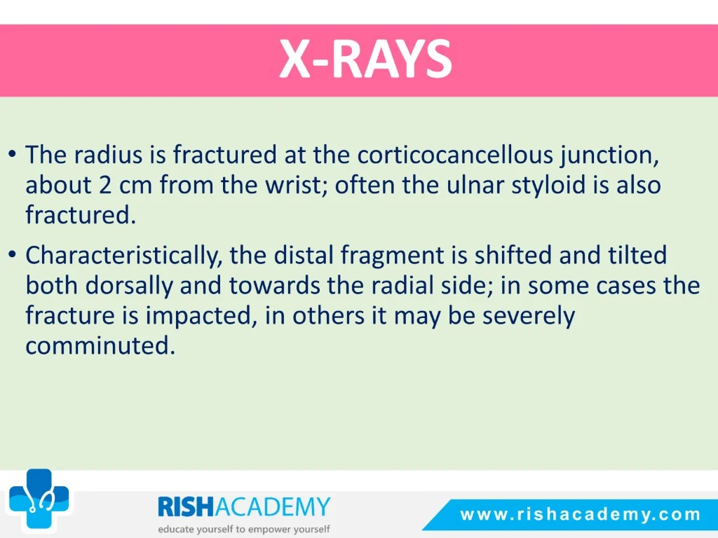 Colles’ & Smith’s Fracture free medical notes rish academy (6)